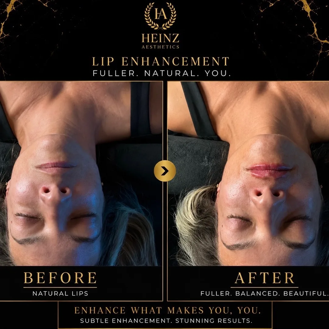 Before and after — lip enhancement